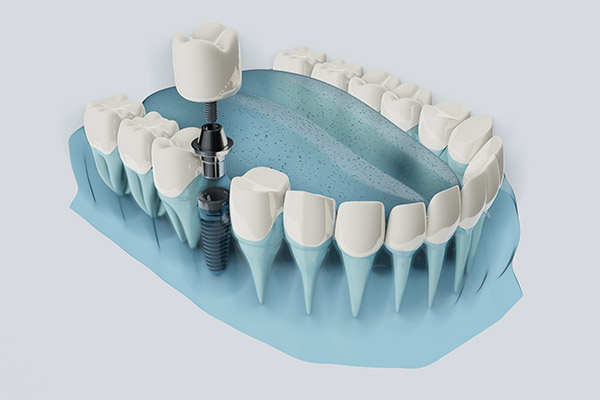 What To Do If A Dental Implant Crown Breaks