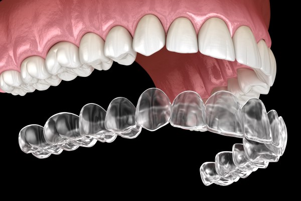 Are Invisalign Aligners Custom Made?